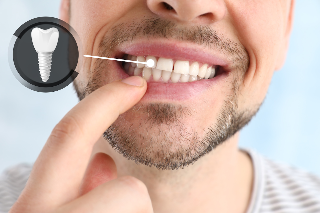 Implant Dentures at Aesthetic Dental & Denture Clinic