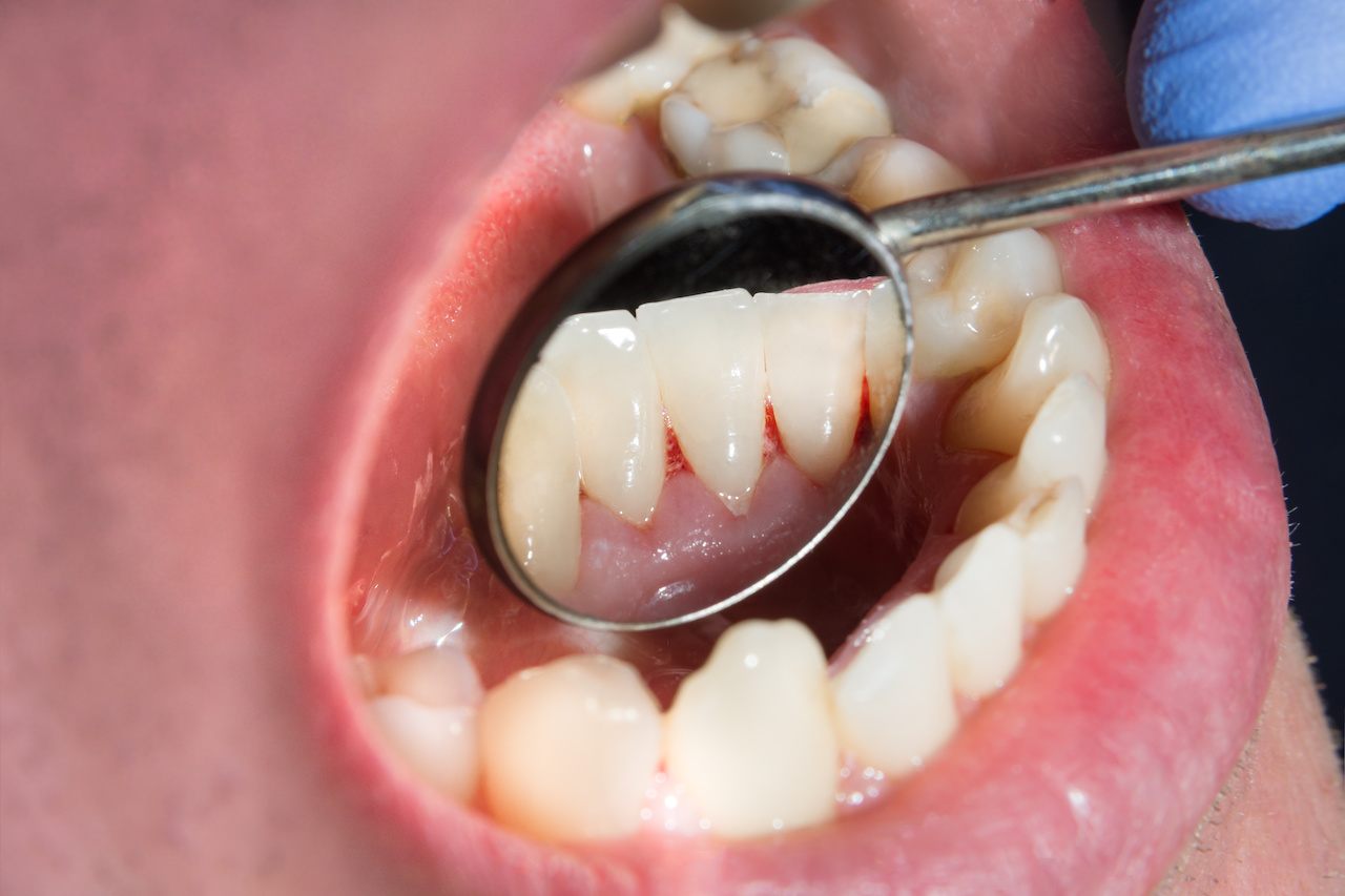 Smokers Teeth at Aesthetic Dental & Denture Clinic