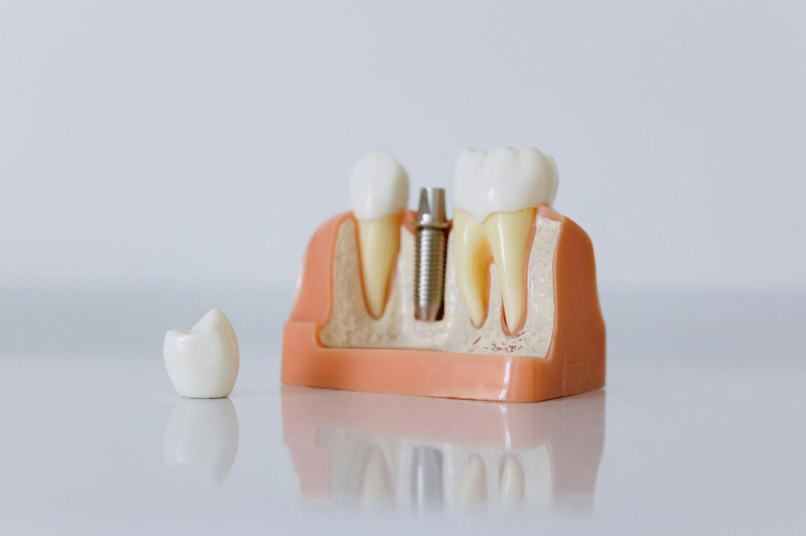 The most common materials to manufacture dental crowns are zirconia, porcelain, and gold.