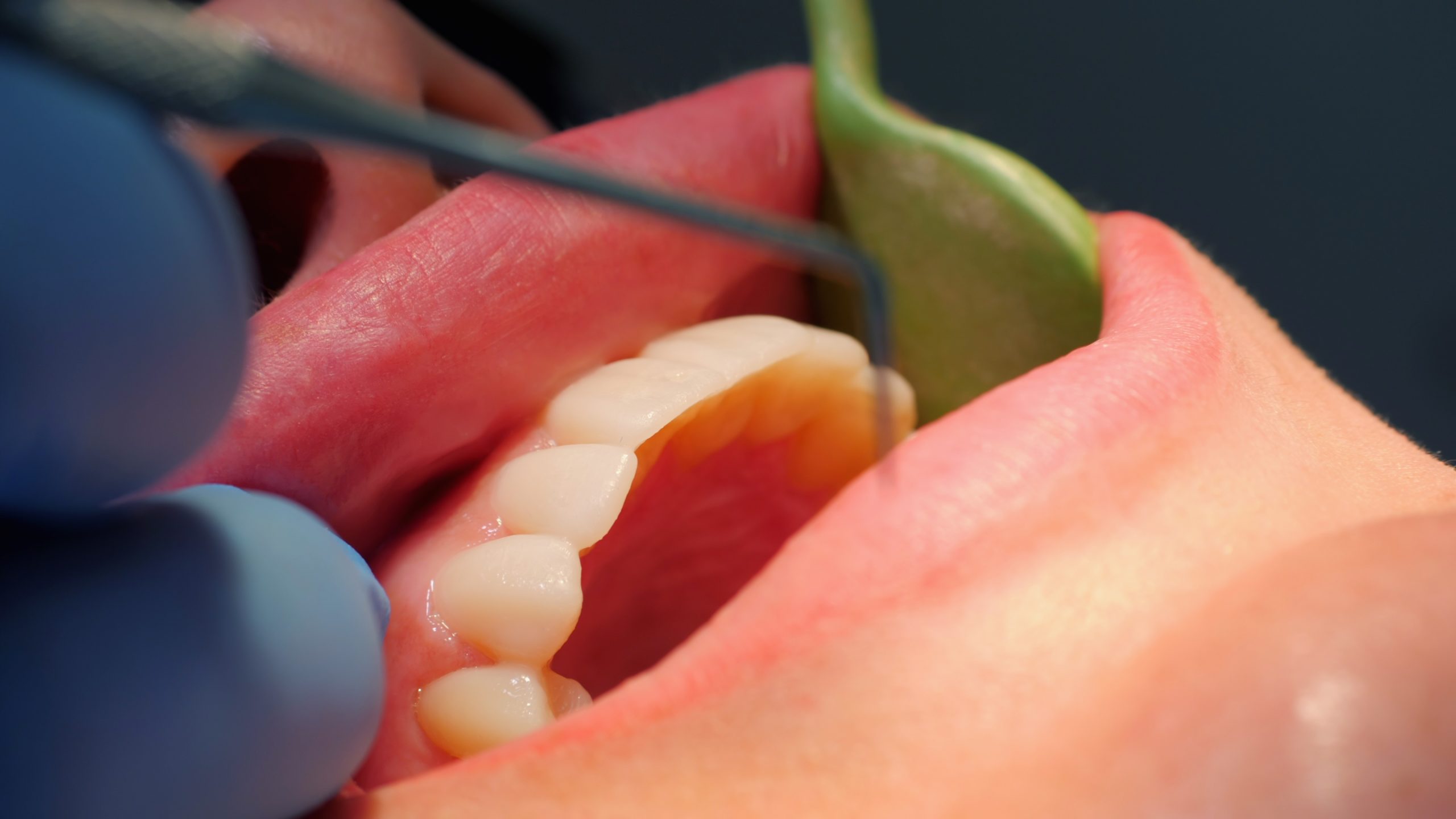 Gum Disease Health Statistics Australia (2026)